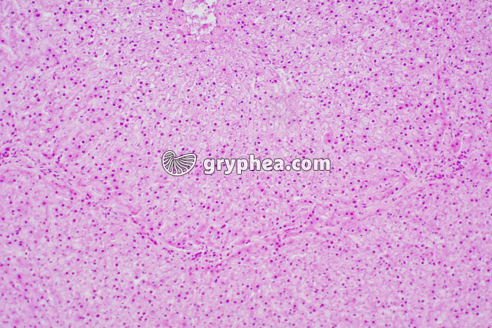 Foie diabétique stéatose x40 - gryphea.org